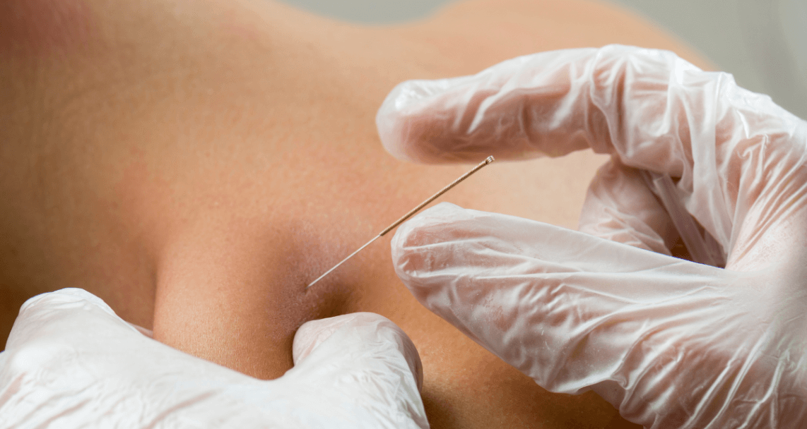 <p element-id="4"><tittle element-id="1"><b element-id="3"></b></tittle></p><b element-id="3"><b> Dry Needling: A Powerful Tool for Pain Relief and Rehabilitation.&nbsp;</b></b>