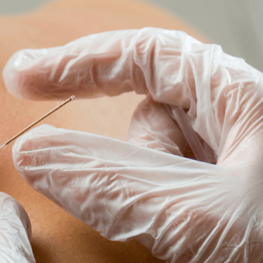 Dry Needling in A Powerful Tool for Pain Relief and Rehabilitation
  image